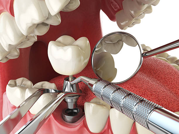 Best Broken or Chipped Tooth Repair in Big Sandy, TX